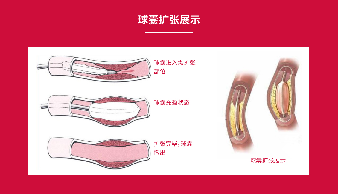 球囊擴(kuò)張導(dǎo)管_10.jpg
